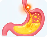Acid reflux and GORD