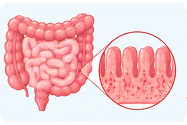 Coeliac disease