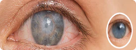 Eyelid & corneal Disease