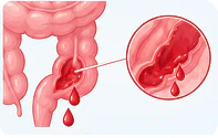 Gastrointestinal bleeding