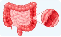Inflammatory bowel disease (IBD)