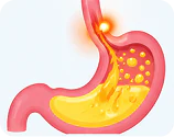 Acid reflux and GORD