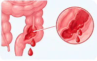 Gastrointestinal bleeding