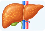 Liver disease and fatty liver