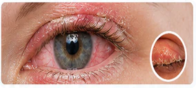 Dry eye disease and blepharitis