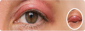 Eyelid & Periocular Conditions