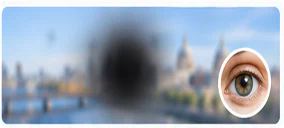 Age-related macular degeneration
