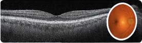 Normal OCT & Specialist Diagnostics